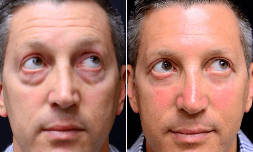 Before & After Blepharoplasty Front View 4