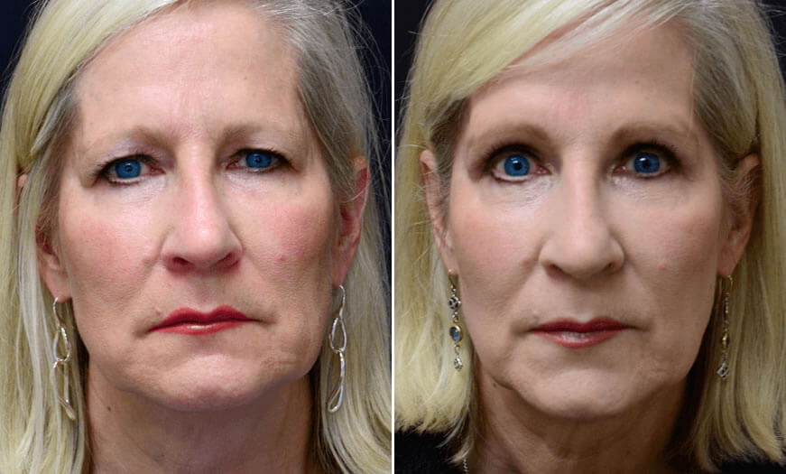 Before & After Blepharoplasty Front View