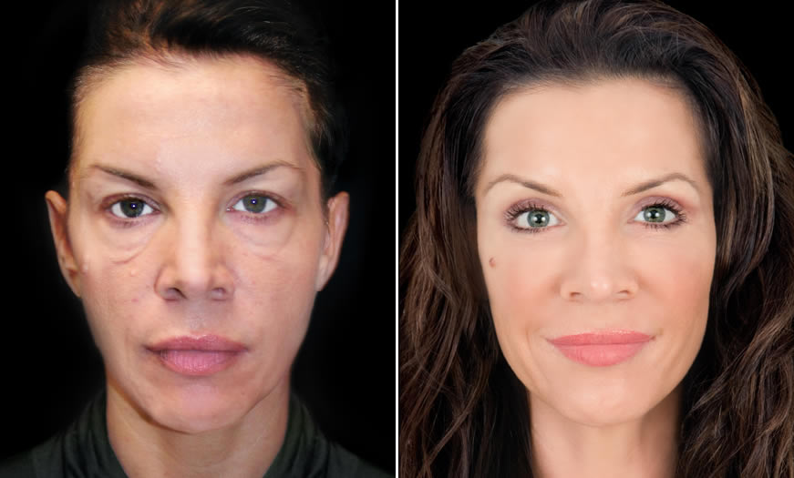 Before & After Blepharoplasty Front View