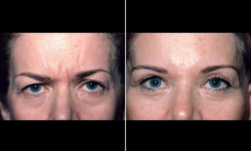 Before & After Blepharoplasty Front View