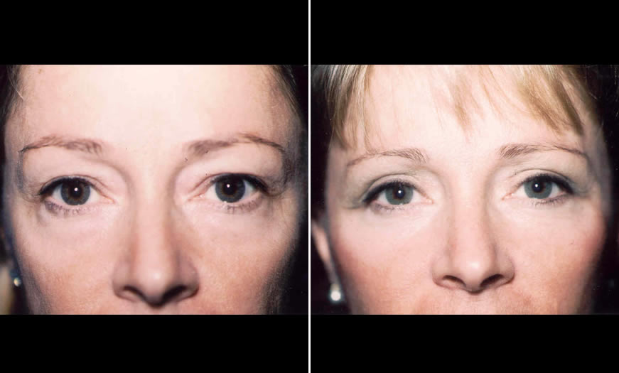 Before & After Blepharoplasty Front View