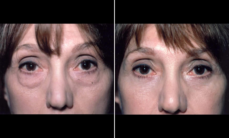 Before & After Blepharoplasty Front View