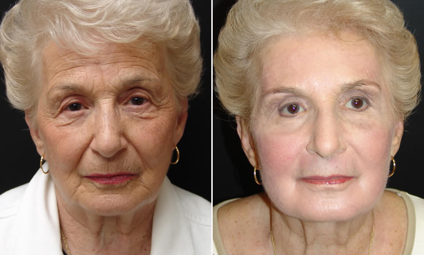 Before & After Blepharoplasty Front View