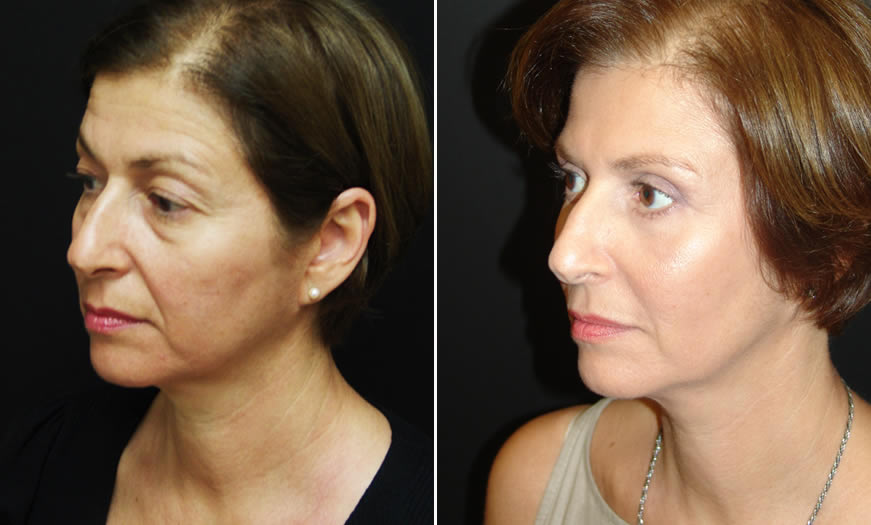 Before & After Blepharoplasty Quarter Left View