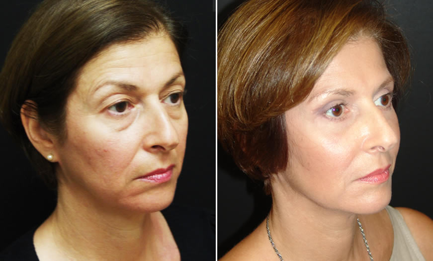 Before & After Blepharoplasty Quarter Right View