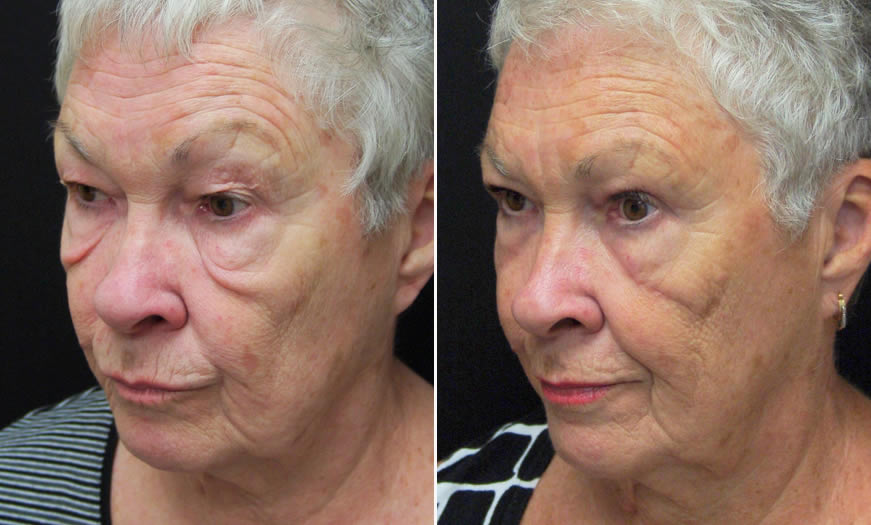 Before & After Blepharoplasty Quarter Left View