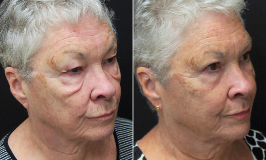 Before & After Blepharoplasty Quarter Right View