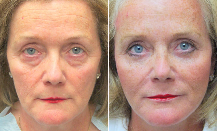 Before & After Blepharoplasty Front View