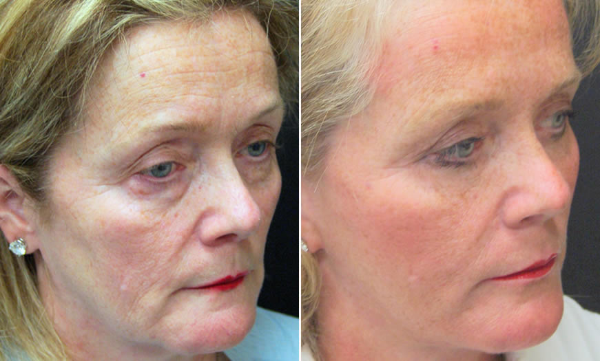 Before & After Blepharoplasty Quarter Right View