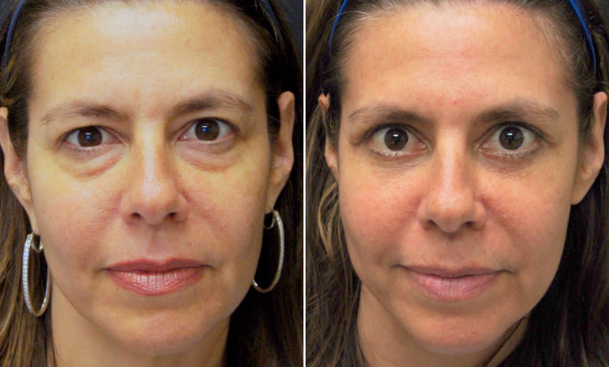 Before & After Blepharoplasty Front View 1