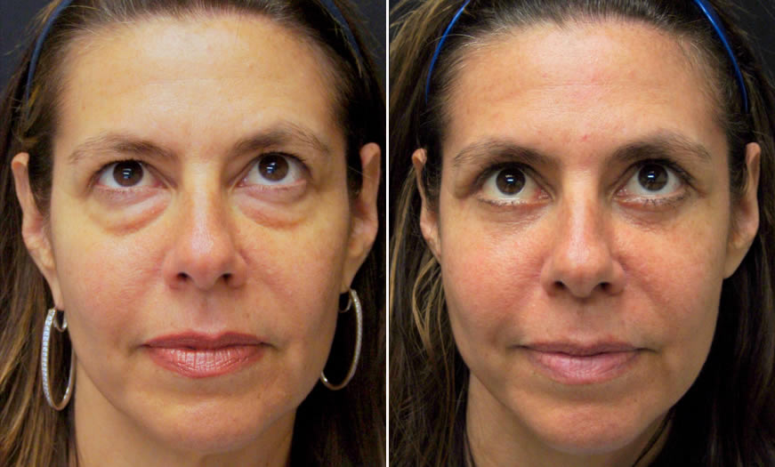 Before & After Blepharoplasty Front View 2
