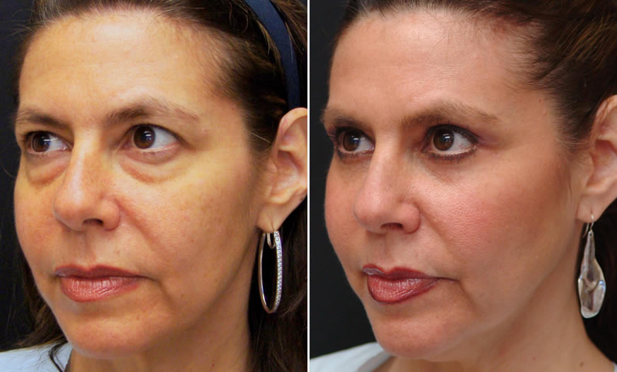 Before & After Blepharoplasty Quarter Left View