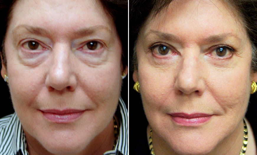 Before & After Blepharoplasty Front View