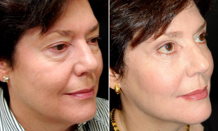 Before & After Blepharoplasty Quarter Right View