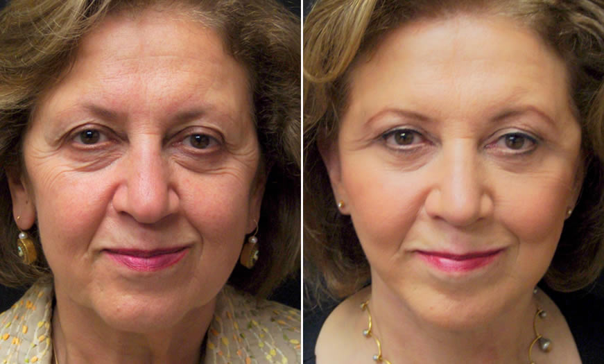 Before & After Blepharoplasty Front View