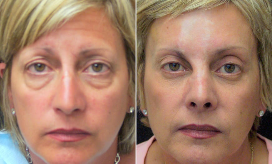 Before & After Blepharoplasty Front View