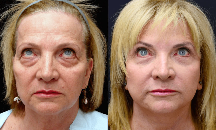 Before & After Face & Neck Lift Front View