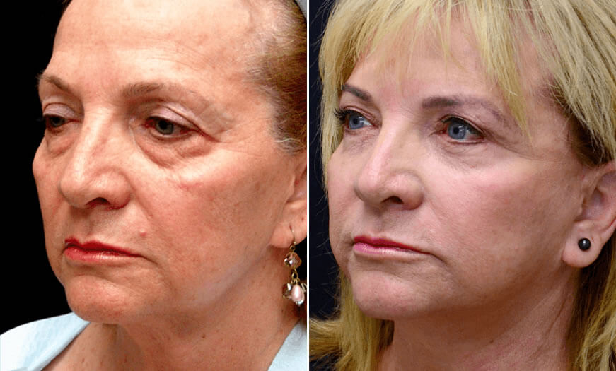 Before & After Face & Neck Lift Quarter Left View