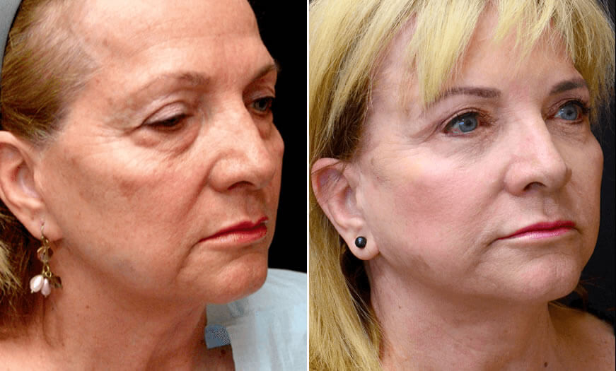 Before & After Face & Neck Lift Quarter Right View