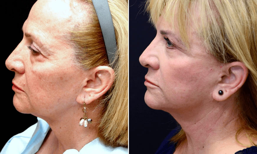 Before & After Face & Neck Lift Side Left View