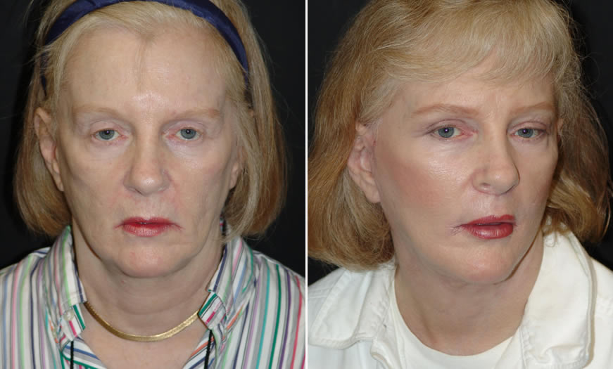 Before & After Face & Neck Lift Front View