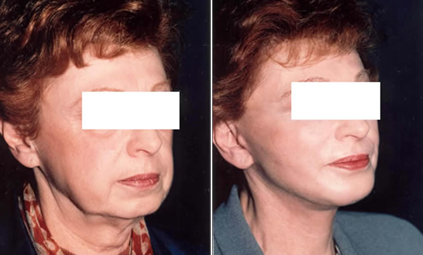 Before & After Face & Neck Lift Quarter Right View