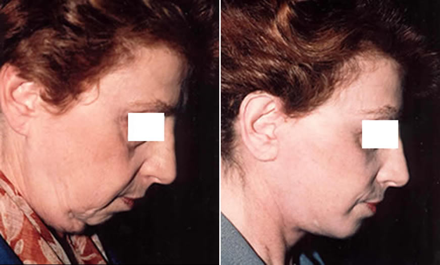 Before & After Face & Neck Lift Side Right View