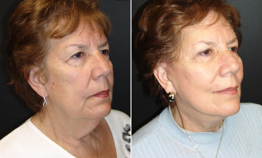 Before & After Face & Neck Lift Quarter Right View