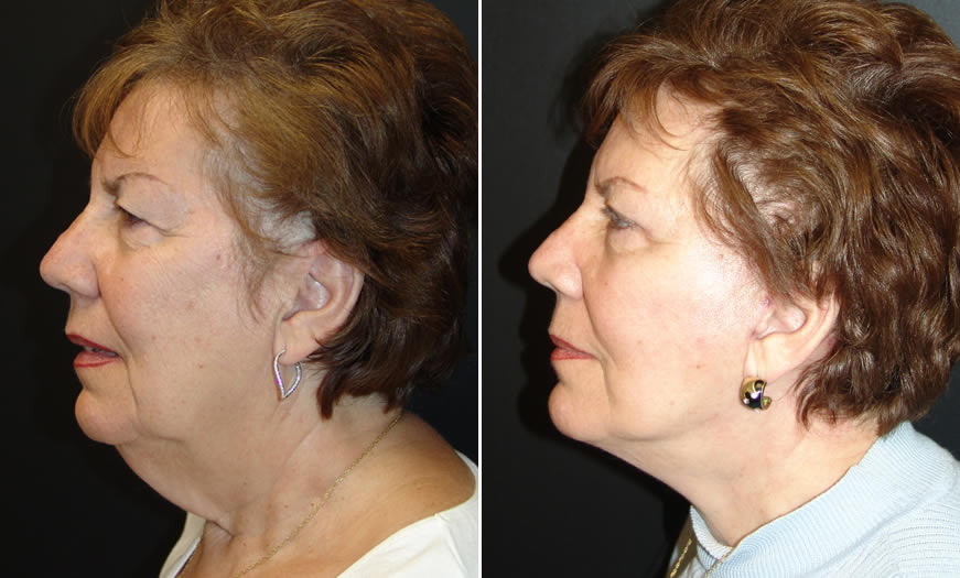 Before & After Face & Neck Lift Side Left View