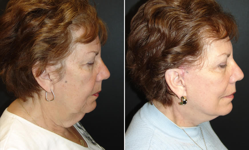 Before & After Face & Neck Lift Side Right View