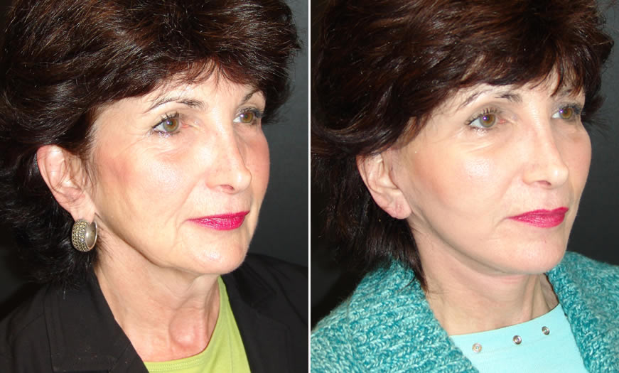 Before & After Face & Neck Lift Quarter Right View