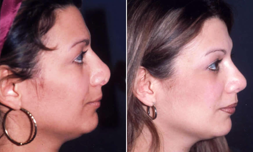 Before & After Secondary Nasal Surgery Side Right View