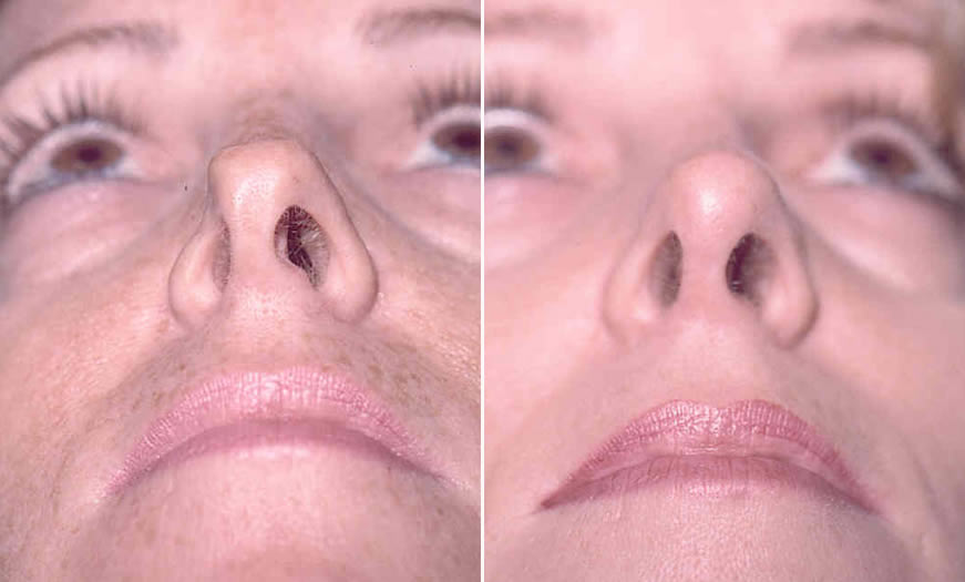 Before & After Secondary Nasal Surgery Front View 2