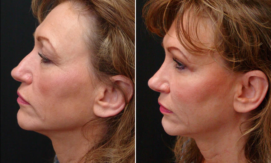 Before & After Secondary Nasal Surgery Side Left View