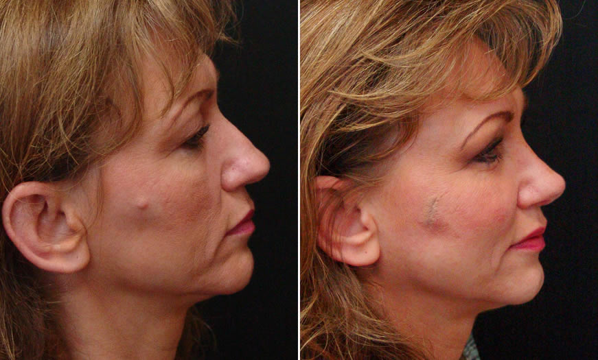 Before & After Secondary Nasal Surgery Side Right View