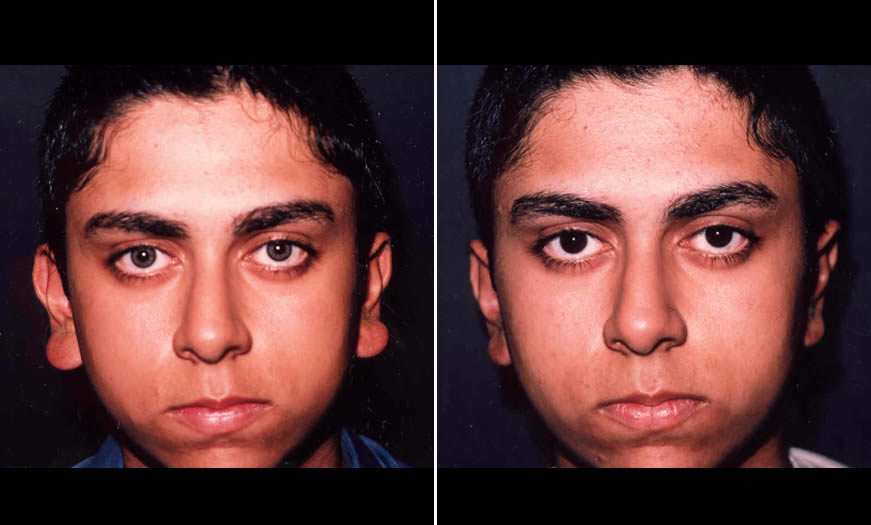 Before & After Otoplasty Front View