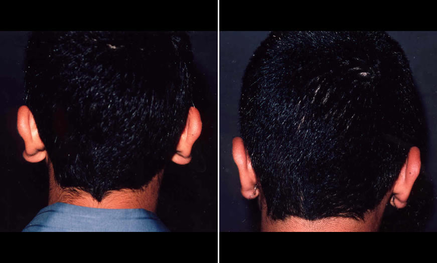Before & After Otoplasty Back View