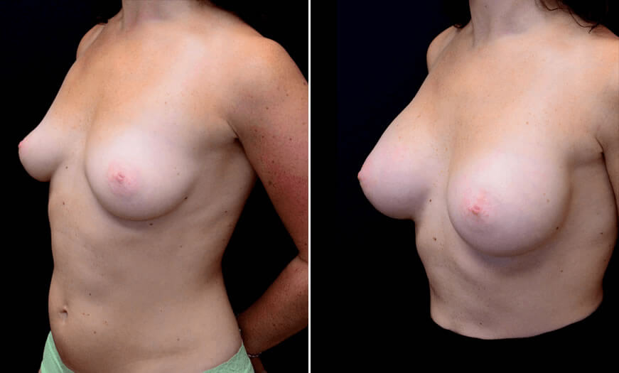 Before & After Breast Augmentation Quarter Left View