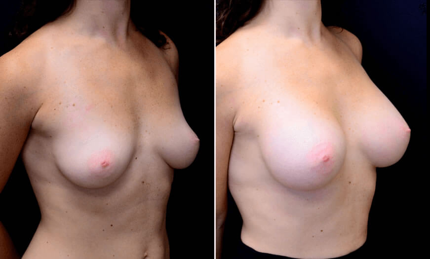 Before & After Breast Augmentation Quarter Right View