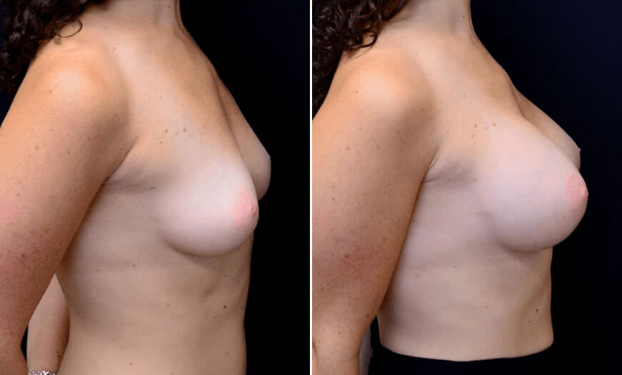 Before & After Breast Augmentation Side Right View