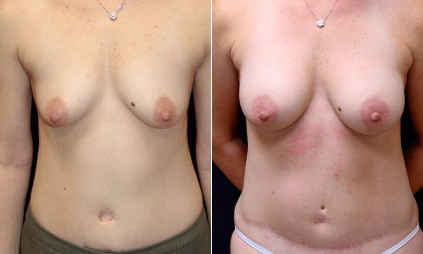 Before & After Breast Augmentation Front View