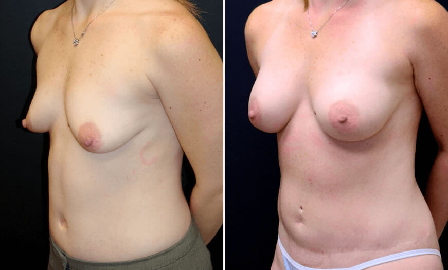 Before & After Breast Augmentation Quarter Left View