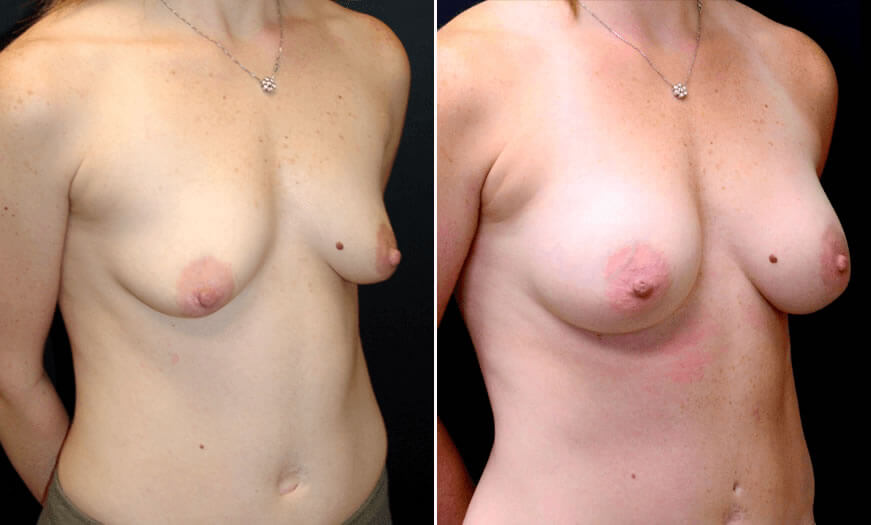 Before & After Breast Augmentation Quarter Right View