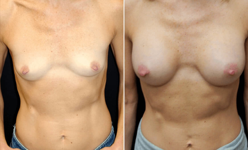 Before & After Breast Augmentation Front View