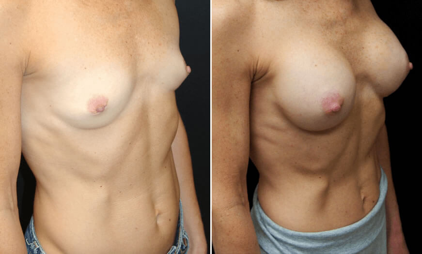 Before & After Breast Augmentation Quarter Right View