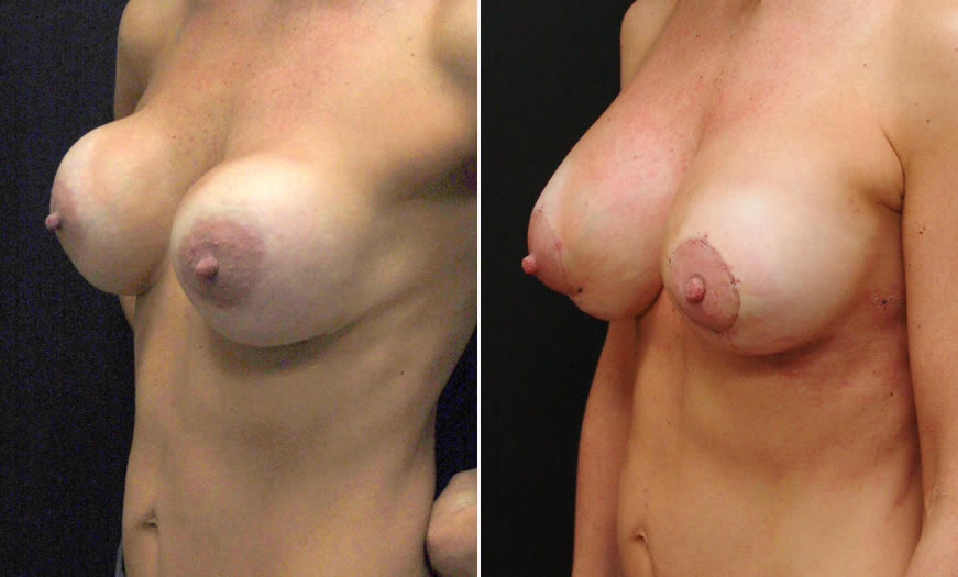 Before & After Breast Augmentation Quarter Left View