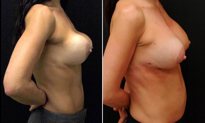 Before & After Breast Augmentation Side Right View