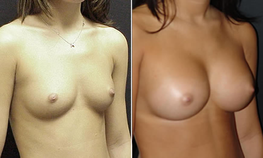 Before & After Breast Augmentation Quarter Right View