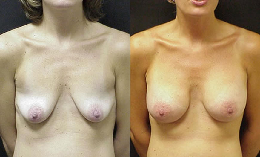 Before & After Breast Augmentation Front View