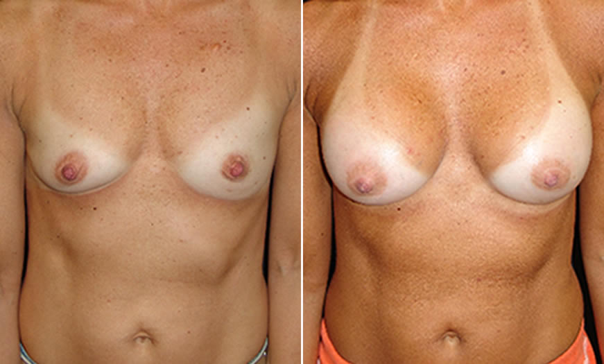 Before & After Breast Augmentation Front View